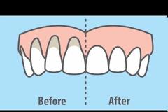 Πώς θα αντιμετωπίσουμε φυσικά την υποχώρηση των ούλων;