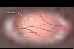 Ραγάδες στο δέρμα: Πώς δημιουργούνται;