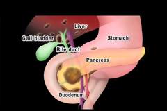 Καρκίνος του Παγκρέατος, από τους πιο θανατηφόρους καρκίνους. Ποια τα 10 συμπτώματα; Νεότερες θεραπείες (video)