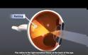 Μήπως ο διαβήτης έχει βλάψει τα μάτια σας; Διαβητική οφθαλμοπάθεια, διαβητική αμφιβληστροειδοπάθεια (video)