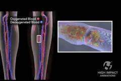 Φλεβική θρόμβωση; Πώς σχηματίζεται ο θρόμβος; Πώς μπορεί να προληφθεί; (video)