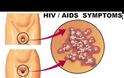 AIDS / HIV : Τα συμπτώματα που επιβάλλεται να τα γνωρίζουν ΟΛΟΙ!