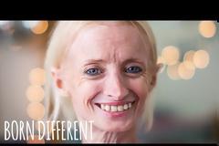 Γυναίκα πάσχει από την σπάνια ασθένεια της πρόωρης γήρανσης και στα 41 της μοιάζει με 90χρονη γιαγιά