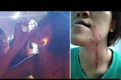 Βίντεο: Νεαρή ήπιε σφηνάκι τεκίλα με... φωτιά και κάηκε το πρόσωπό της