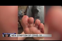 Τι είναι το δυσάρεστο σύμπτωμα στα πόδια που εμφανίζουν κάποιοι ασθενείς και δείχνουν κοροναϊό