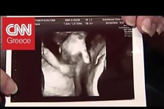 Συγκλονιστικό! Έμβρυο αποχαιρετάει το δίδυμο αδελφάκι του (Video)