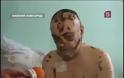 Krokodil: Σοκαριστικές εικόνες από χρήστες του ναρκωτικού που τρώει τη σάρκα