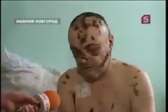 Krokodil: Σοκαριστικές εικόνες από χρήστες του ναρκωτικού που τρώει τη σάρκα