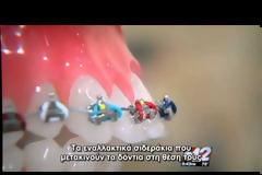 Ορθοδοντική Επαναστατική Τεχνολογία αλλάζει τον τρόπο μετακίνησης των δοντιών