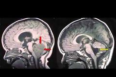 Όγκος στο κεφάλι: Πώς θα τον καταλάβετε – Ποιοι κινδυνεύουν [video]